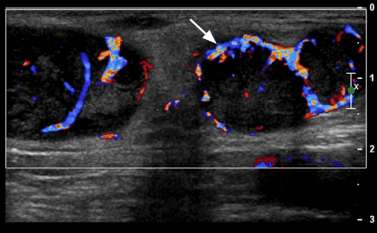 リンパ節腫脹の診察や画像所見は?